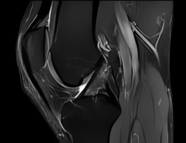 IRM du genou IRM des Sources