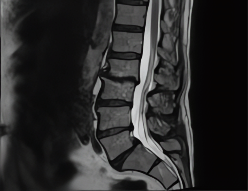 IRM Colonne Lombaire IRM Des Sources