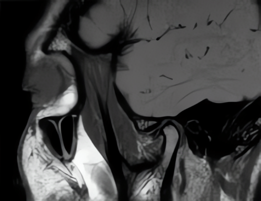 IRM des articulations temporo-maxillaire