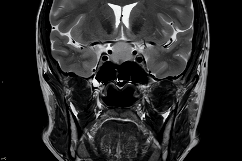 irm hypophysaire à Lyon - réduit