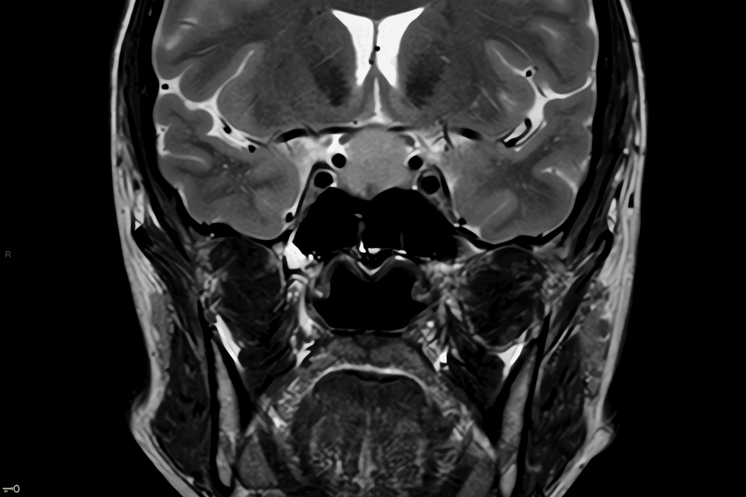 irm hypophysaire à Lyon - réduit